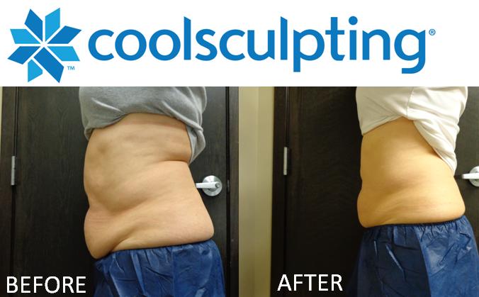 CoolSculpt1